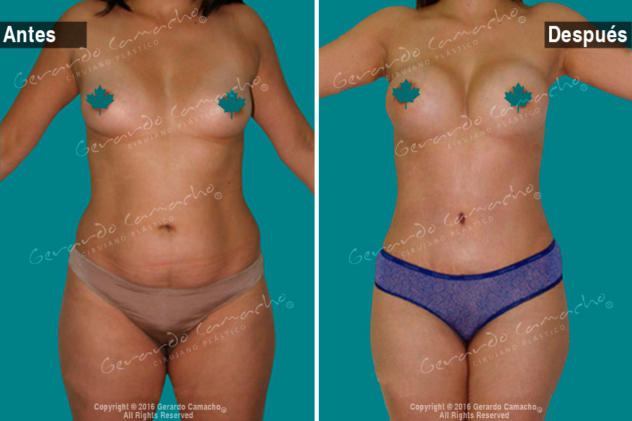  Mommy Makeover Bogota